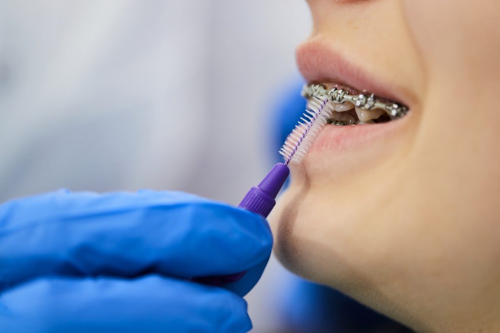 Close-up of dentist using interdental brush and cleaning dental braces of little girl at dental clinic.